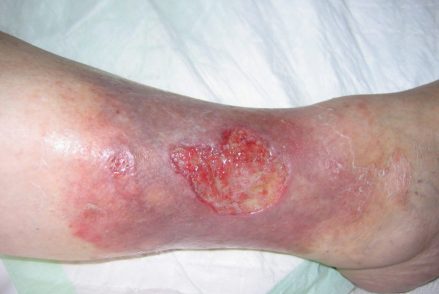Venous Leg Ulcer