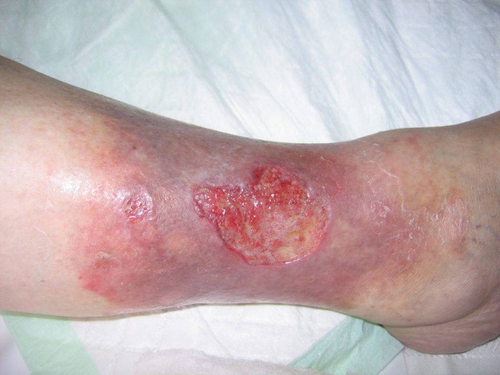 Venous Leg Ulcer - Urgo Medical Healthcare Professionals