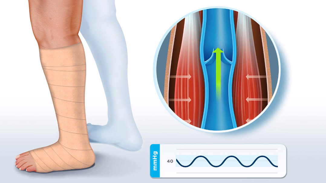 Understanding compression therapy for venous and mixed leg ulcers