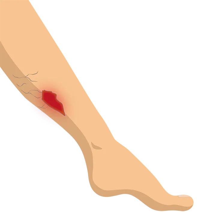Leg ulcers - Urgo Medical tells you more about it